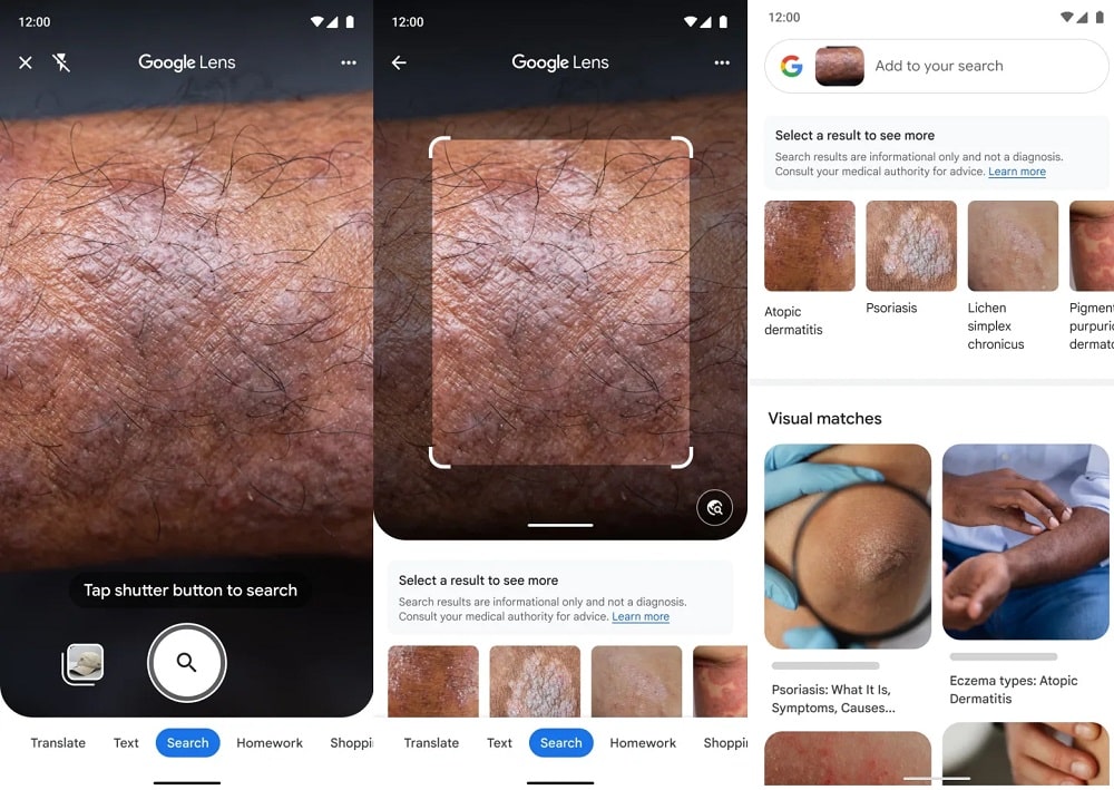 Google Lens skin diseases min